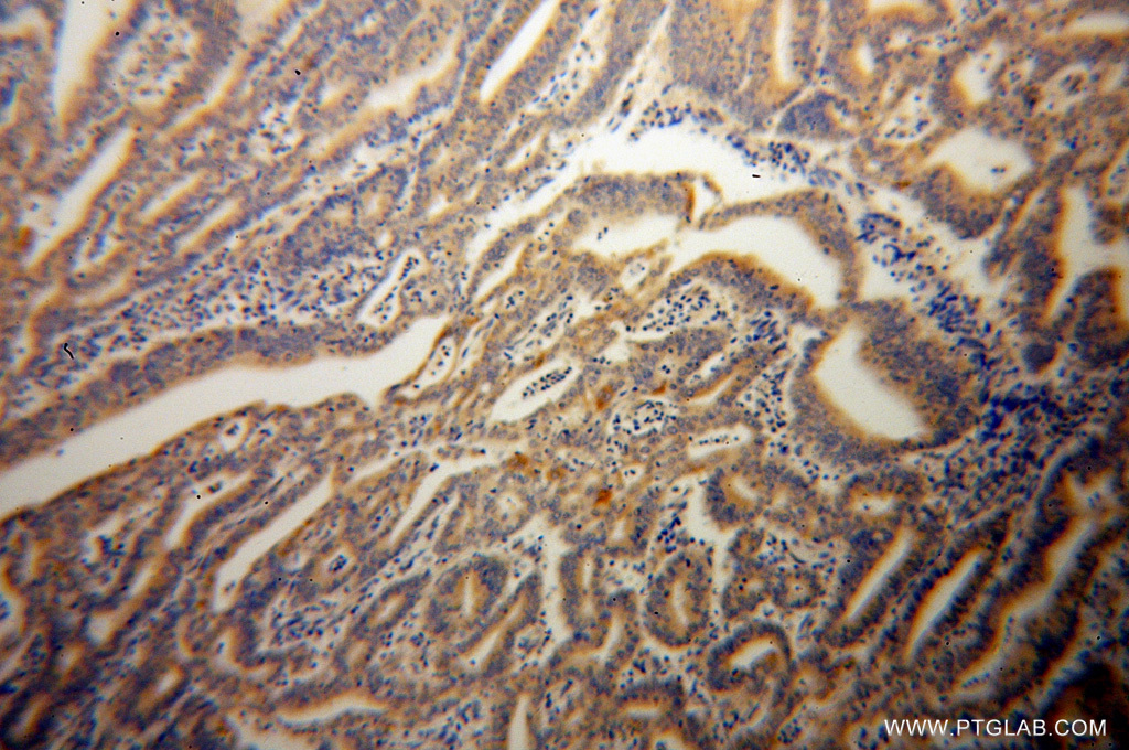 Immunohistochemistry of paraffin-embedded human endometrial cancer using 14311-1-AP (CASP10 antibody