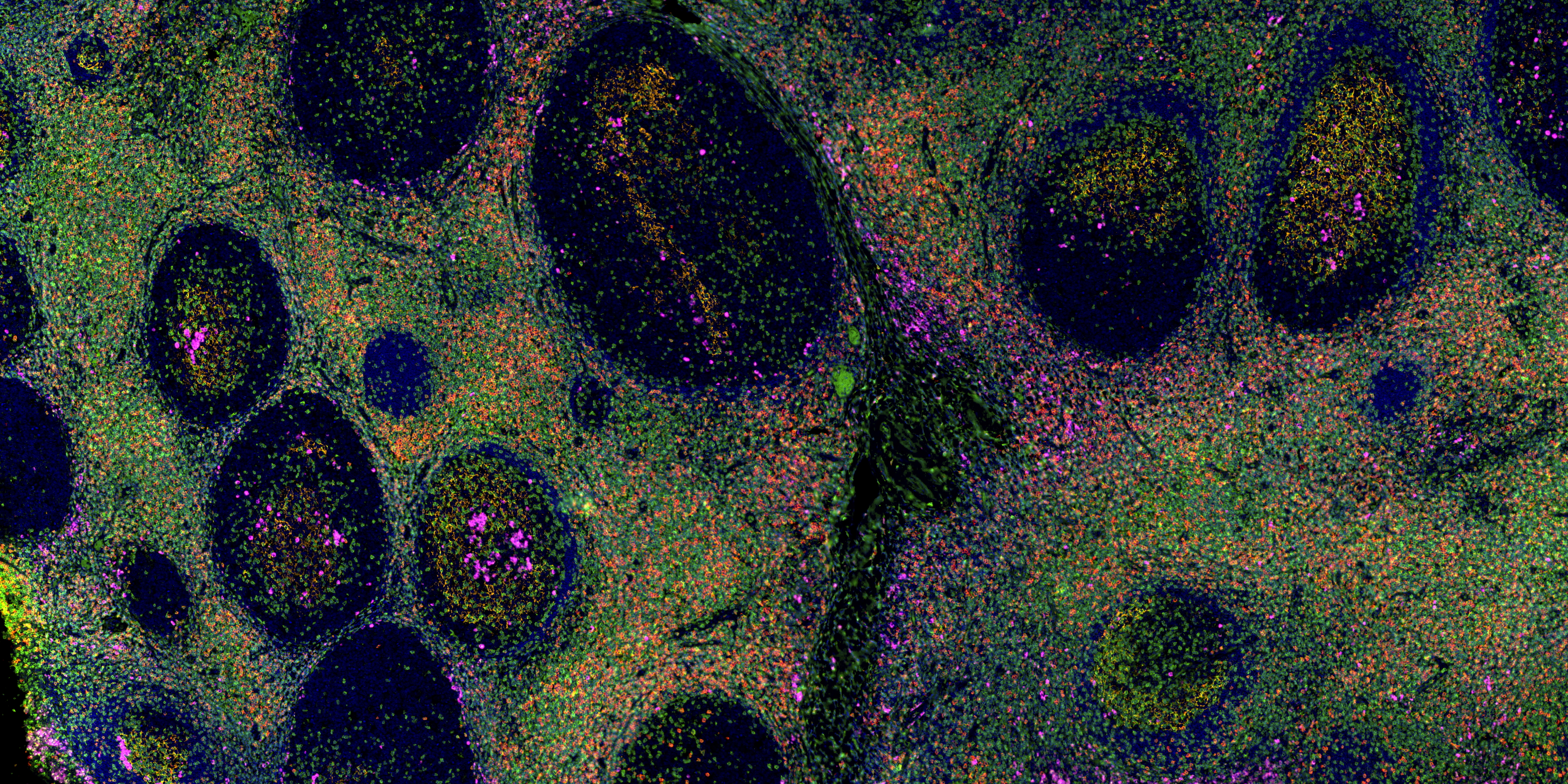 IF staining using using PK10034 (Five color TSA Detect Kit for Rabbit/Mouse Primary Antibody).
FFPE-human tonsillitis tissue was stained with CD23 monoclonal antibody (60208-2-Ig) at 1:8000 followed by detection with Multi-rAb® Polymer HRP-Goat Anti-Rabbit/Mouse Universal Recombinant Secondary Antibody (H+L). CoraLite®Plus 555-Tyramide Reagent was used for signal development (yellow). The slide was then conducted HIER in pH 9.0 Tris-EDTA buffer followed by staining with CD3 monoclonal antibody (60181-1-Ig, 1:10000). CoraLite®Plus 488-Tyramide Reagent were used for signal development (green). Similarly, CD8a monoclonal antibody (66868-1-Ig, 1:20000) and CD138 monoclonal antibody (67155-1-Ig, 1:10000) were stained subsequently. CoraLite®Plus 594-Tyramide Reagent (red) and CoraLite®Plus 647-Tyramide Reagent (purple) were used for signal development respectively. Finally, cell nucleus (blue) were stained with DAPI. The signal from each channel was captured and merged. IF staining using using PK10034 (Five color TSA Detect Kit for Rabbit/Mouse Primary Antibody).
FFPE-human tonsillitis tissue was stained with CD23 monoclonal antibody (60208-2-Ig) at 1:8000 followed by detection with Multi-rAb® Polymer HRP-Goat Anti-Rabbit/Mouse Universal Recombinant Secondary Antibody (H+L). CoraLite®Plus 555-Tyramide Reagent was used for signal development (yellow). The slide was then conducted HIER in pH 9.0 Tris-EDTA buffer followed by staining with CD3 monoclonal antibody (60181-1-Ig, 1:10000). CoraLite®Plus 488-Tyramide Reagent were used for signal development (green). Similarly, CD8a monoclonal antibody (66868-1-Ig, 1:20000) and CD138 monoclonal antibody (67155-1-Ig, 1:10000) were stained subsequently. CoraLite®Plus 594-Tyramide Reagent (red) and CoraLite®Plus 647-Tyramide Reagent (purple) were used for signal development respectively. Finally, cell nucleus (blue) were stained with DAPI. The signal from each channel was captured and merged.