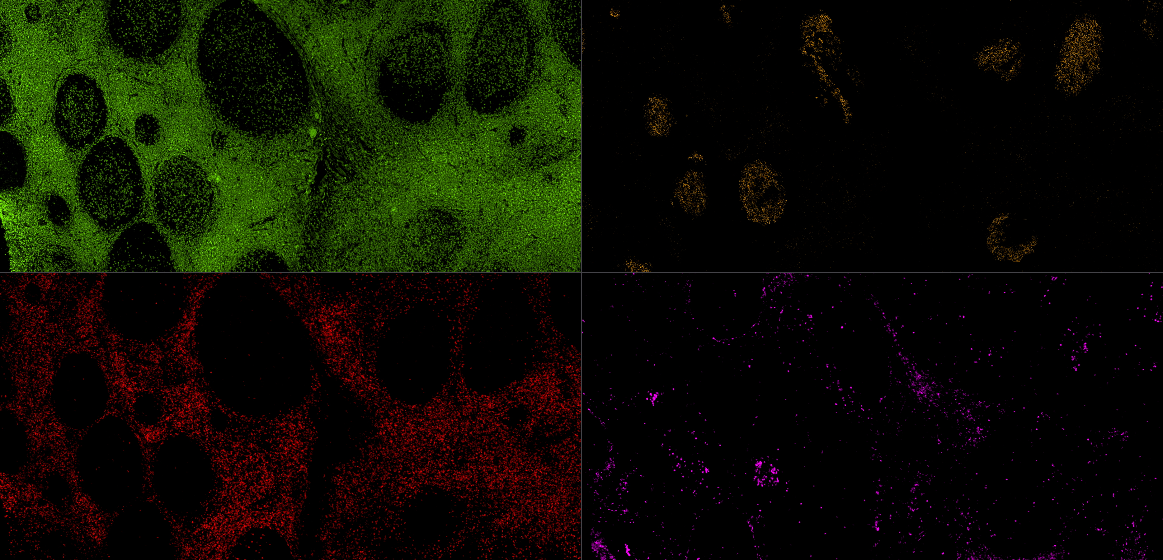 IF staining using using PK10034 (Five color TSA Detect Kit for Rabbit/Mouse Primary Antibody).
FFPE-human tonsillitis tissue was stained with CD23 monoclonal antibody (60208-2-Ig) at 1:8000 followed by detection with Multi-rAb® Polymer HRP-Goat Anti-Rabbit/Mouse Universal Recombinant Secondary Antibody (H+L). CoraLite®Plus 555-Tyramide Reagent was used for signal development (yellow). The slide was then conducted HIER in pH 9.0 Tris-EDTA buffer followed by staining with CD3 monoclonal antibody (60181-1-Ig, 1:10000). CoraLite®Plus 488-Tyramide Reagent were used for signal development (green). Similarly, CD8a monoclonal antibody (66868-1-Ig, 1:20000) and CD138 monoclonal antibody (67155-1-Ig, 1:10000) were stained subsequently. CoraLite®Plus 594-Tyramide Reagent (red) and CoraLite®Plus 647-Tyramide Reagent (purple) were used for signal development respectively. Finally, cell nucleus (blue) were stained with DAPI. IF staining using using PK10034 (Five color TSA Detect Kit for Rabbit/Mouse Primary Antibody).
FFPE-human tonsillitis tissue was stained with CD23 monoclonal antibody (60208-2-Ig) at 1:8000 followed by detection with Multi-rAb® Polymer HRP-Goat Anti-Rabbit/Mouse Universal Recombinant Secondary Antibody (H+L). CoraLite®Plus 555-Tyramide Reagent was used for signal development (yellow). The slide was then conducted HIER in pH 9.0 Tris-EDTA buffer followed by staining with CD3 monoclonal antibody (60181-1-Ig, 1:10000). CoraLite®Plus 488-Tyramide Reagent were used for signal development (green). Similarly, CD8a monoclonal antibody (66868-1-Ig, 1:20000) and CD138 monoclonal antibody (67155-1-Ig, 1:10000) were stained subsequently. CoraLite®Plus 594-Tyramide Reagent (red) and CoraLite®Plus 647-Tyramide Reagent (purple) were used for signal development respectively. Finally, cell nucleus (blue) were stained with DAPI.