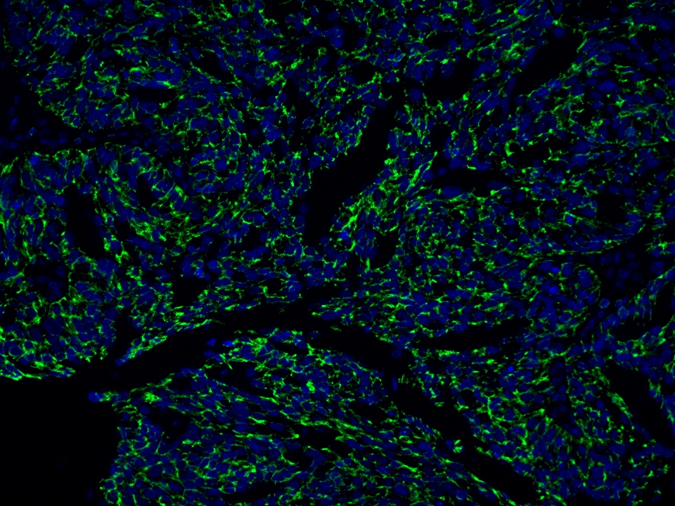 IF Staining using CoraLite®Plus 488-Tyramide Reagent PR30022. 
FFPE-human ovary cancer tissue was stained with 66180-1-Ig (CD71 Monoclonal antibody) at 1:10000 followed by detection with Multi-rAb® Polymer HRP-Goat Anti-Rabbit/Mouse Universal Recombinant Secondary Antibody (H+L) (Cat.NO. RGAU011). CoraLite®Plus 488-Tyramide Reagent (Cat.NO. PR30022) was used for signal development. Cell nucleus (blue) was stained with DAPI.  IF Staining using CoraLite®Plus 488-Tyramide Reagent PR30022. 
FFPE-human ovary cancer tissue was stained with 66180-1-Ig (CD71 Monoclonal antibody) at 1:10000 followed by detection with Multi-rAb® Polymer HRP-Goat Anti-Rabbit/Mouse Universal Recombinant Secondary Antibody (H+L) (Cat.NO. RGAU011). CoraLite®Plus 488-Tyramide Reagent (Cat.NO. PR30022) was used for signal development. Cell nucleus (blue) was stained with DAPI.
