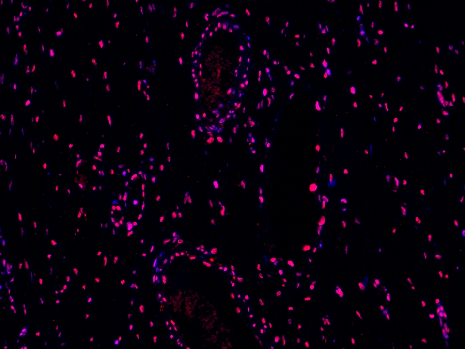 IF Staining using CoraLite®Plus 594-Tyramide Reagent PR30024. 
FFPE-human ovary cancer tissue was stained with 14015-1-AP (STAG1 polyclonal antibody) at 1:1000 followed by detection with Multi-rAb® Polymer HRP-Goat Anti-Rabbit/Mouse Universal Recombinant Secondary Antibody (H+L) (Cat.NO. RGAU011). CoraLite®Plus 594-Tyramide Reagent (Cat.NO. PR30024) was used for signal development. Cell nucleus (blue) was stained with DAPI. IF Staining using CoraLite®Plus 594-Tyramide Reagent PR30024. 
FFPE-human ovary cancer tissue was stained with 14015-1-AP (STAG1 polyclonal antibody) at 1:1000 followed by detection with Multi-rAb® Polymer HRP-Goat Anti-Rabbit/Mouse Universal Recombinant Secondary Antibody (H+L) (Cat.NO. RGAU011). CoraLite®Plus 594-Tyramide Reagent (Cat.NO. PR30024) was used for signal development. Cell nucleus (blue) was stained with DAPI.