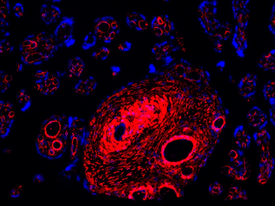 IF Staining using CoraLite®Plus 594-Tyramide Reagent PR30024. 
FFPE-human placenta tissue was stained with 67882-1-Ig (LPCAT3 Monoclonal antibody) at 1:1000 followed by detection with Multi-rAb® Polymer HRP-Goat Anti-Rabbit/Mouse Universal Recombinant Secondary Antibody (H+L) (Cat.NO. RGAU011). CoraLite®Plus 594-Tyramide Reagent (Cat.NO. PR30024) was used for signal development. Cell nucleus (blue) was stained with DAPI. IF Staining using CoraLite®Plus 594-Tyramide Reagent PR30024. 
FFPE-human placenta tissue was stained with 67882-1-Ig (LPCAT3 Monoclonal antibody) at 1:1000 followed by detection with Multi-rAb® Polymer HRP-Goat Anti-Rabbit/Mouse Universal Recombinant Secondary Antibody (H+L) (Cat.NO. RGAU011). CoraLite®Plus 594-Tyramide Reagent (Cat.NO. PR30024) was used for signal development. Cell nucleus (blue) was stained with DAPI.