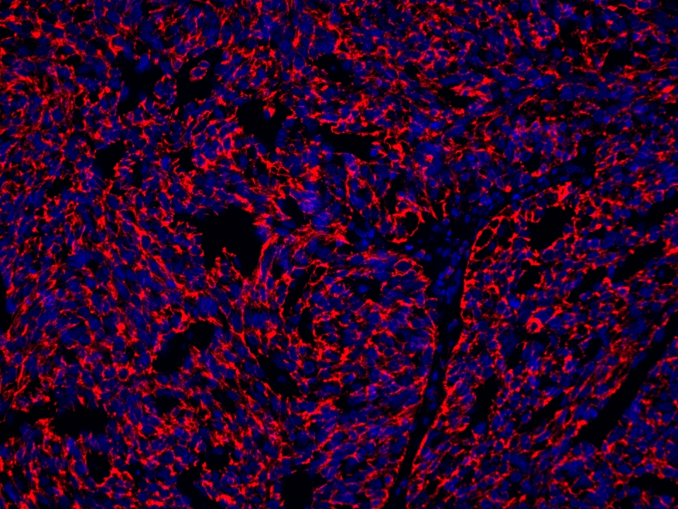 IF Staining using CoraLite®Plus 594-Tyramide Reagent PR30024. 
FFPE-human ovary cancer tissue was stained with 66180-1-Ig (CD71 Monoclonal antibody) at 1:10000 followed by detection with Multi-rAb® Polymer HRP-Goat Anti-Rabbit/Mouse Universal Recombinant Secondary Antibody (H+L) (Cat.NO. RGAU011). CoraLite®Plus 594-Tyramide Reagent (Cat.NO. PR30024) was used for signal development. Cell nucleus (blue) was stained with DAPI.  IF Staining using CoraLite®Plus 594-Tyramide Reagent PR30024. 
FFPE-human ovary cancer tissue was stained with 66180-1-Ig (CD71 Monoclonal antibody) at 1:10000 followed by detection with Multi-rAb® Polymer HRP-Goat Anti-Rabbit/Mouse Universal Recombinant Secondary Antibody (H+L) (Cat.NO. RGAU011). CoraLite®Plus 594-Tyramide Reagent (Cat.NO. PR30024) was used for signal development. Cell nucleus (blue) was stained with DAPI.