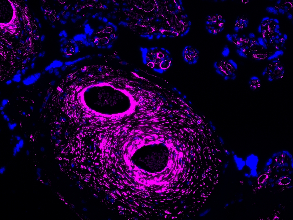 IF Staining using CoraLite®Plus 647-Tyramide Reagent PR30025. 
FFPE-human placenta tissue was stained with 67882-1-Ig (LPCAT3 Monoclonal antibody) at 1:1000 followed by detection of Multi-rAb® Polymer HRP-Goat Anti-Rabbit/Mouse Universal Recombinant Secondary Antibody (H+L) (Cat.NO. RGAU011). CoraLite®Plus 647-Tyramide Reagent (Cat.NO. PR30025) was used for signal development. Cell nucleus (blue) was stained with DAPI. IF Staining using CoraLite®Plus 647-Tyramide Reagent PR30025. 
FFPE-human placenta tissue was stained with 67882-1-Ig (LPCAT3 Monoclonal antibody) at 1:1000 followed by detection of Multi-rAb® Polymer HRP-Goat Anti-Rabbit/Mouse Universal Recombinant Secondary Antibody (H+L) (Cat.NO. RGAU011). CoraLite®Plus 647-Tyramide Reagent (Cat.NO. PR30025) was used for signal development. Cell nucleus (blue) was stained with DAPI.
