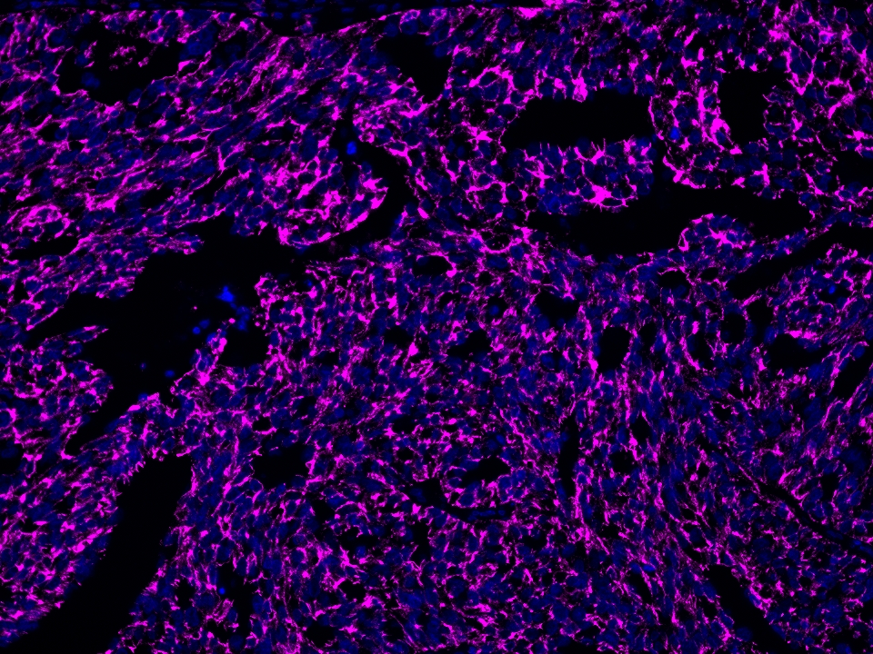 IF Staining using CoraLite®Plus 647-Tyramide Reagent PR30025. 
FFPE-human ovary cancer tissue was stained with 66180-1-Ig (CD71 Monoclonal antibody) at 1:10000 followed by detection of Multi-rAb® Polymer HRP-Goat Anti-Rabbit/Mouse Universal Recombinant Secondary Antibody (H+L) (Cat.NO. RGAU011). CoraLite®Plus 647-Tyramide Reagent (Cat.NO. PR30025) was used for signal development. Cell nucleus (blue) was stained with DAPI.  IF Staining using CoraLite®Plus 647-Tyramide Reagent PR30025. 
FFPE-human ovary cancer tissue was stained with 66180-1-Ig (CD71 Monoclonal antibody) at 1:10000 followed by detection of Multi-rAb® Polymer HRP-Goat Anti-Rabbit/Mouse Universal Recombinant Secondary Antibody (H+L) (Cat.NO. RGAU011). CoraLite®Plus 647-Tyramide Reagent (Cat.NO. PR30025) was used for signal development. Cell nucleus (blue) was stained with DAPI.